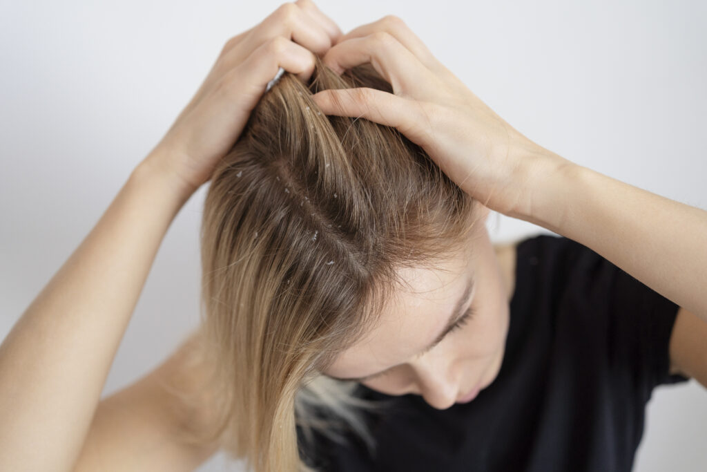 close-up-woman-with-dandruff-issues-